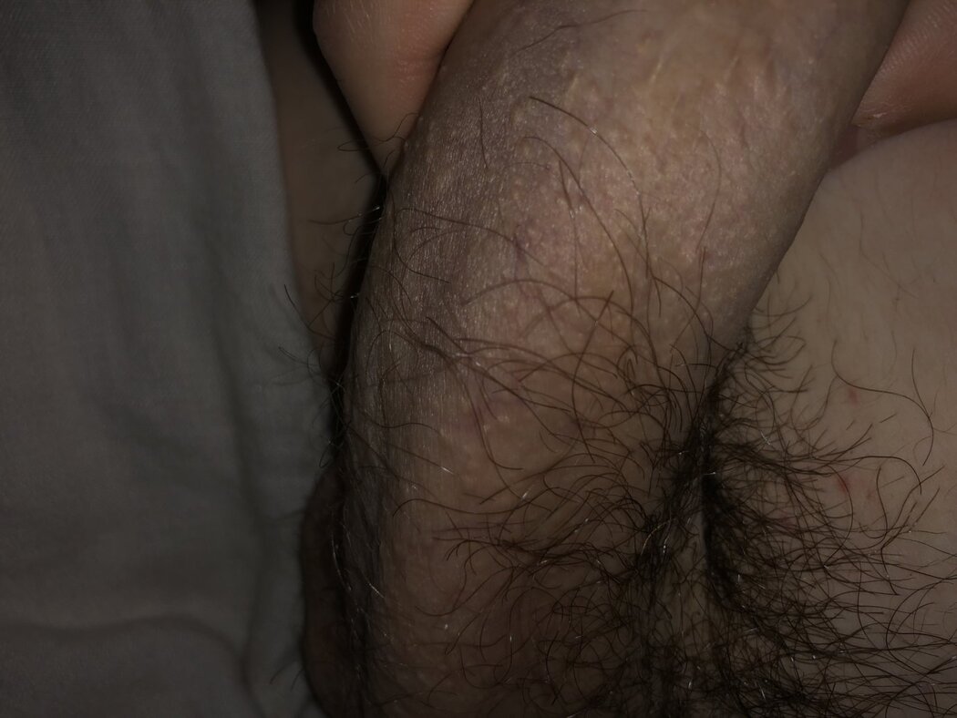 Warts In Porn
