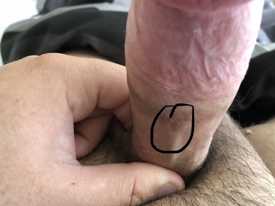 Warts In Porn