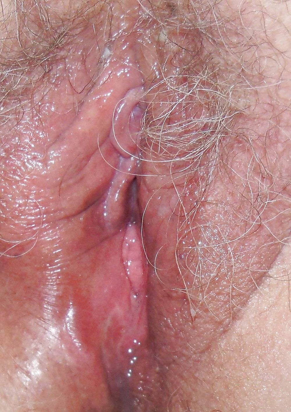 Warts In Porn