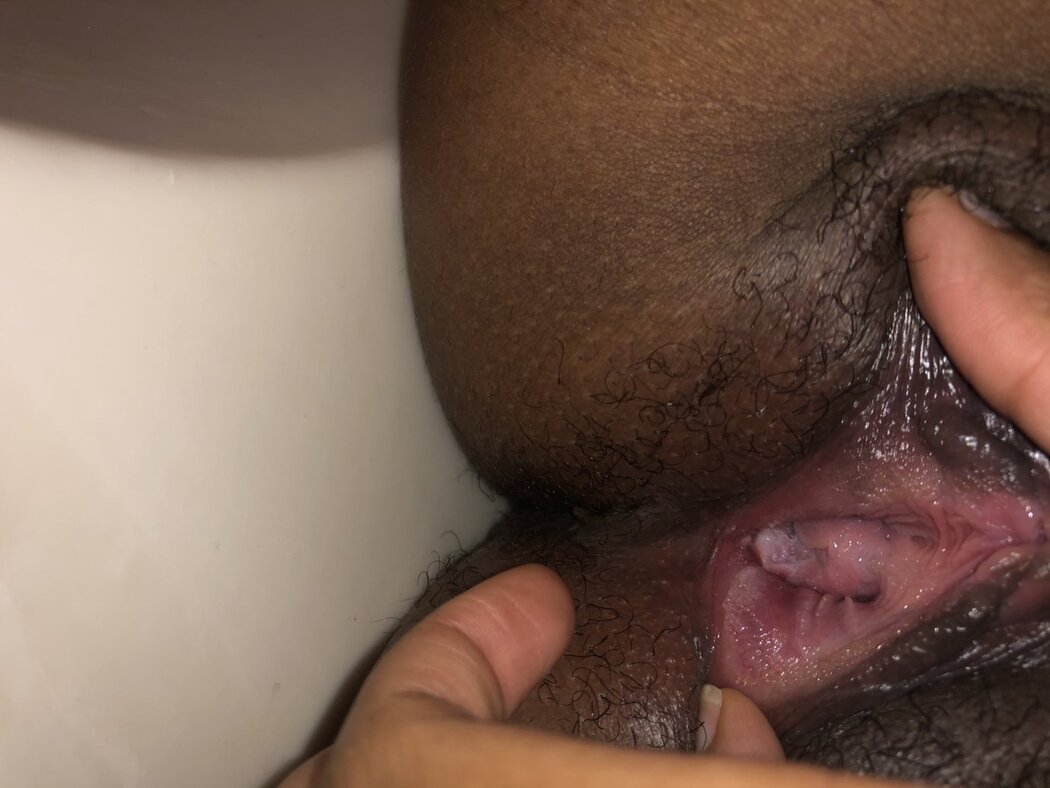 Warts In Porn
