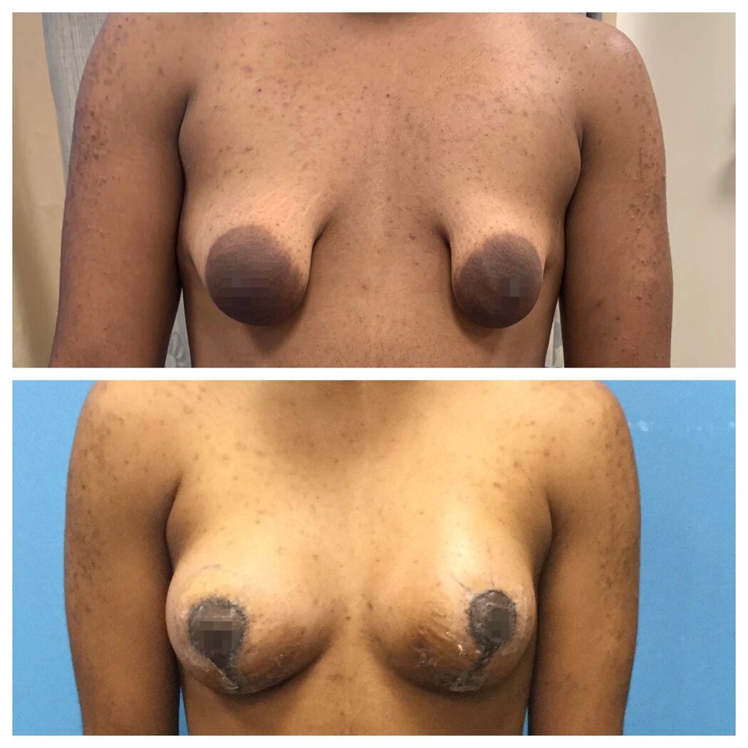 Bare Boobs Cancer