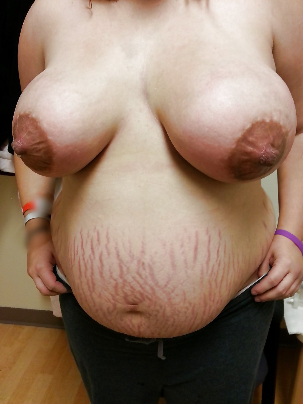 Huge Tits In Stretch Marks