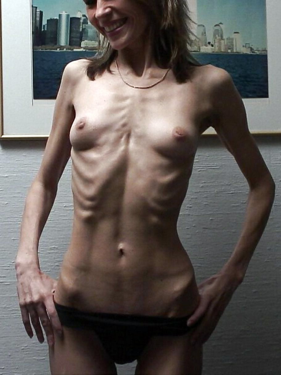 Anorexic Nude Girl