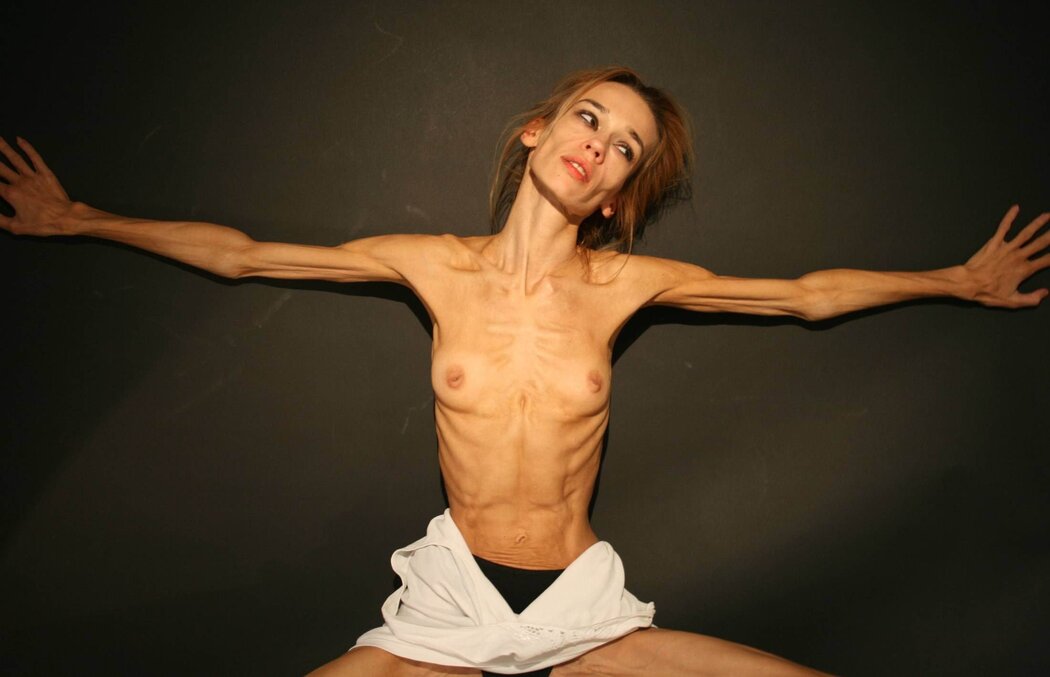 Anorexic Nude Girl