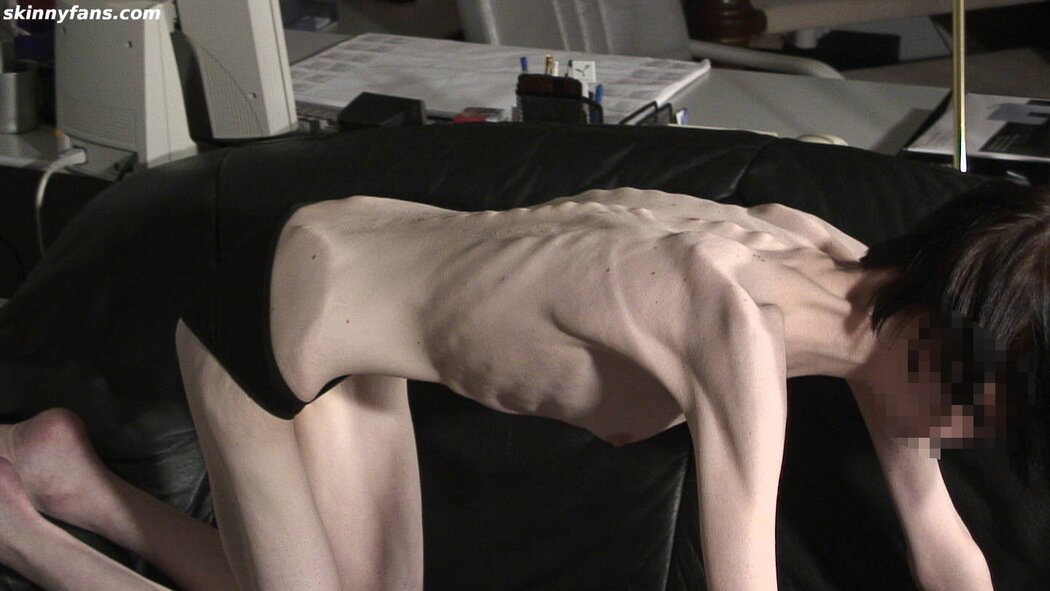Anorexic Nude Girl