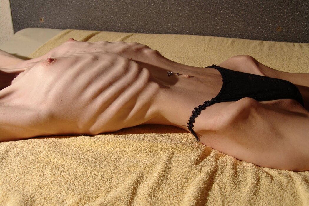 Anorexic Nude Girl