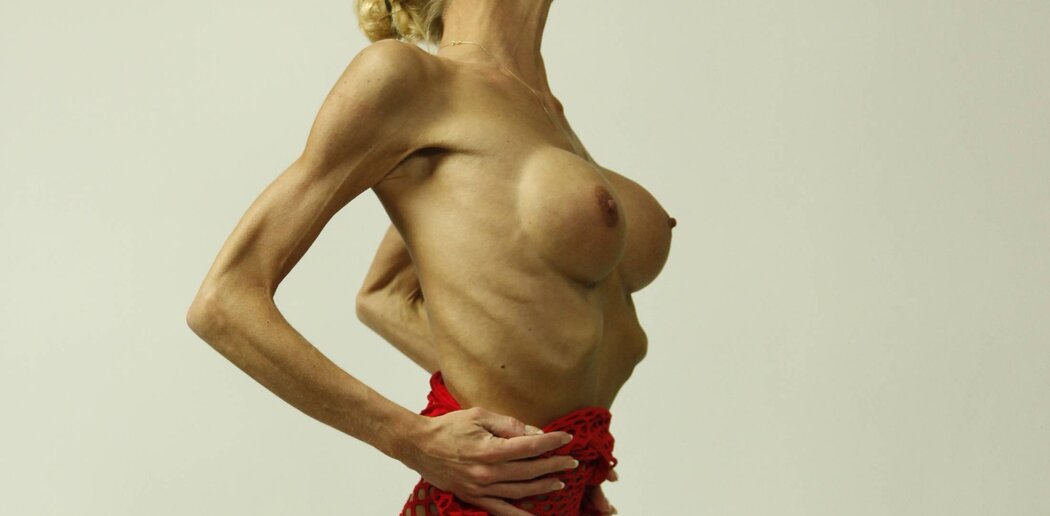 Anorexic Nude Girl