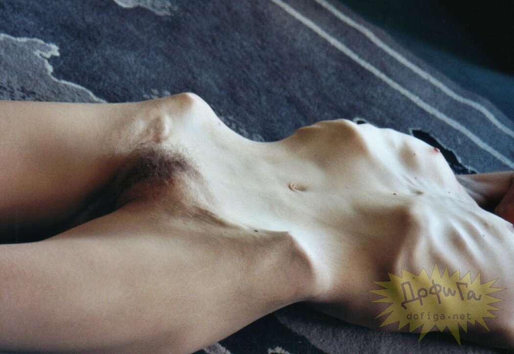 Anorexic Nude Girl