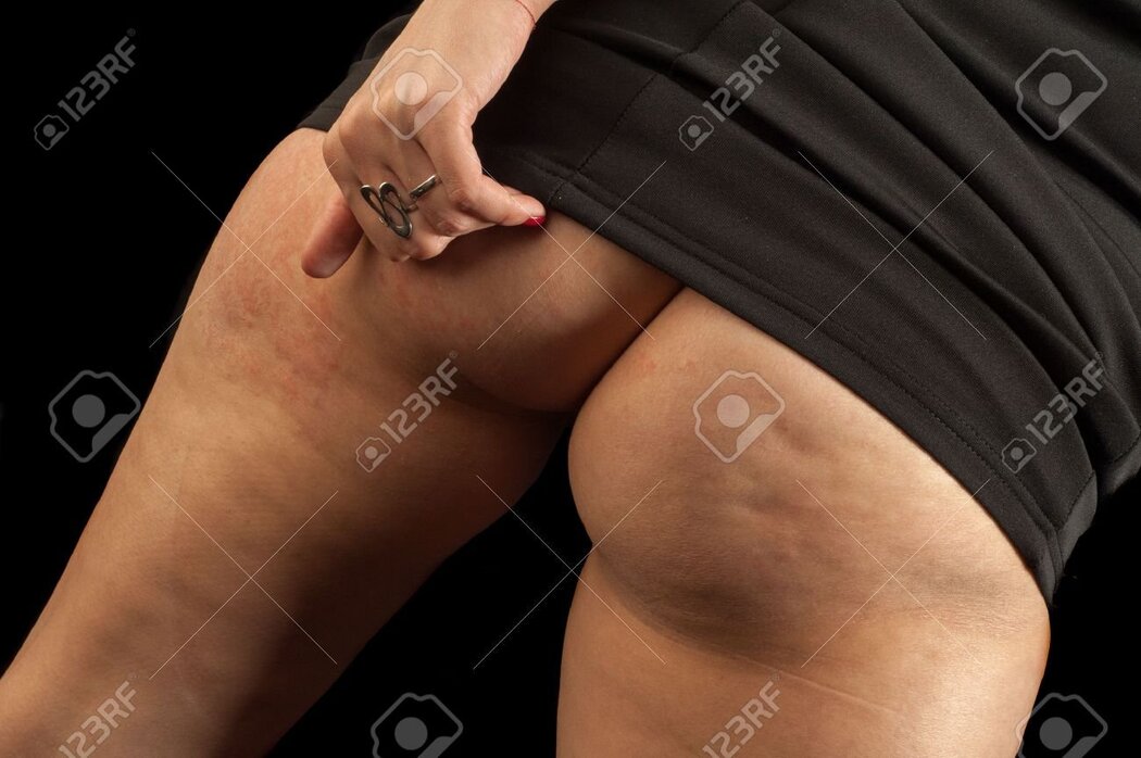Cellulite Nudes
