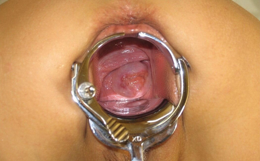 Cervix Porno